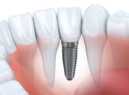 Courtenay Dentist, Dental Implants